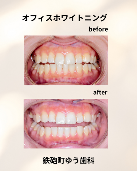 オフィスホワイトニング